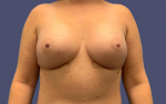 Breast Augmentation 20 After